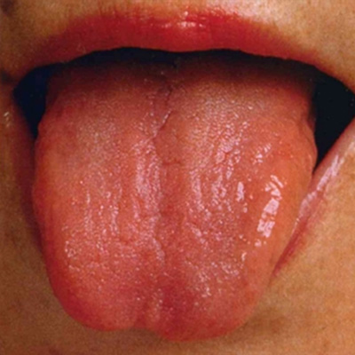 舌の状態6