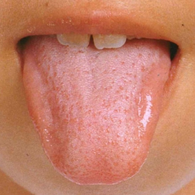 舌の状態1