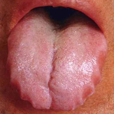 舌の状態2